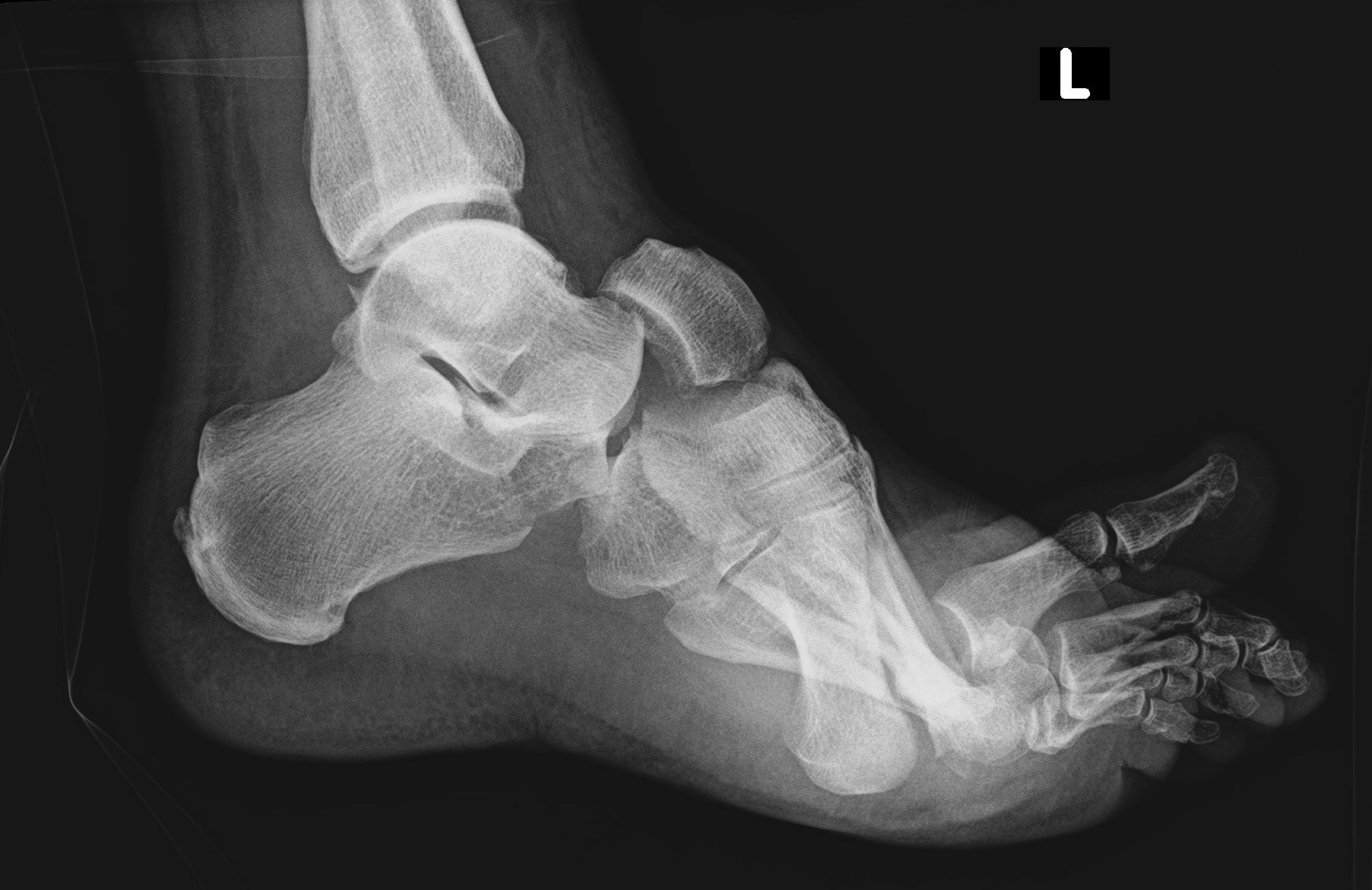 navicular fracture icd 10 code
